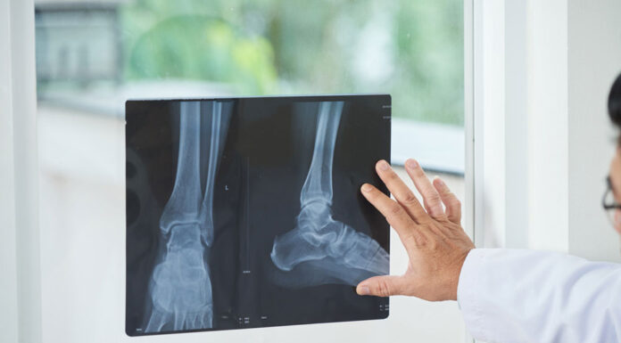 Рентген конечностей: когда нужен, что показывает и как подготовиться
